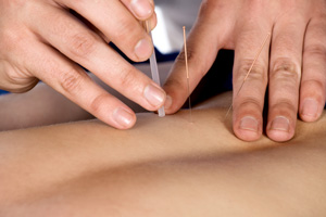 Acupuncture - Needles-in back