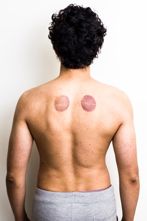 Cupping Marks on back
