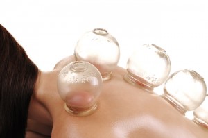 Fire cupping used to increase blood flow, release tight tissue and circulate vital energy