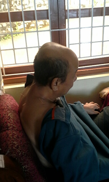 nepal-acupunture-man-back2